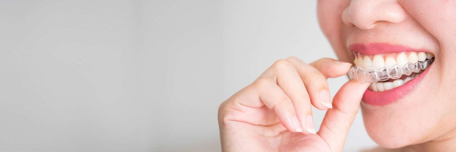 SimplyClear™ Aligners | Dentist