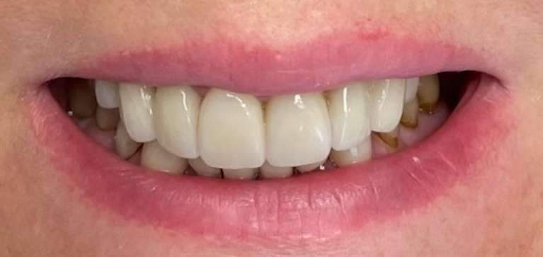 Cosmetic-Crowns-After-Image