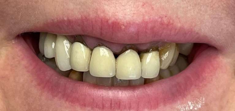Cosmetic-Crowns-Before-Image